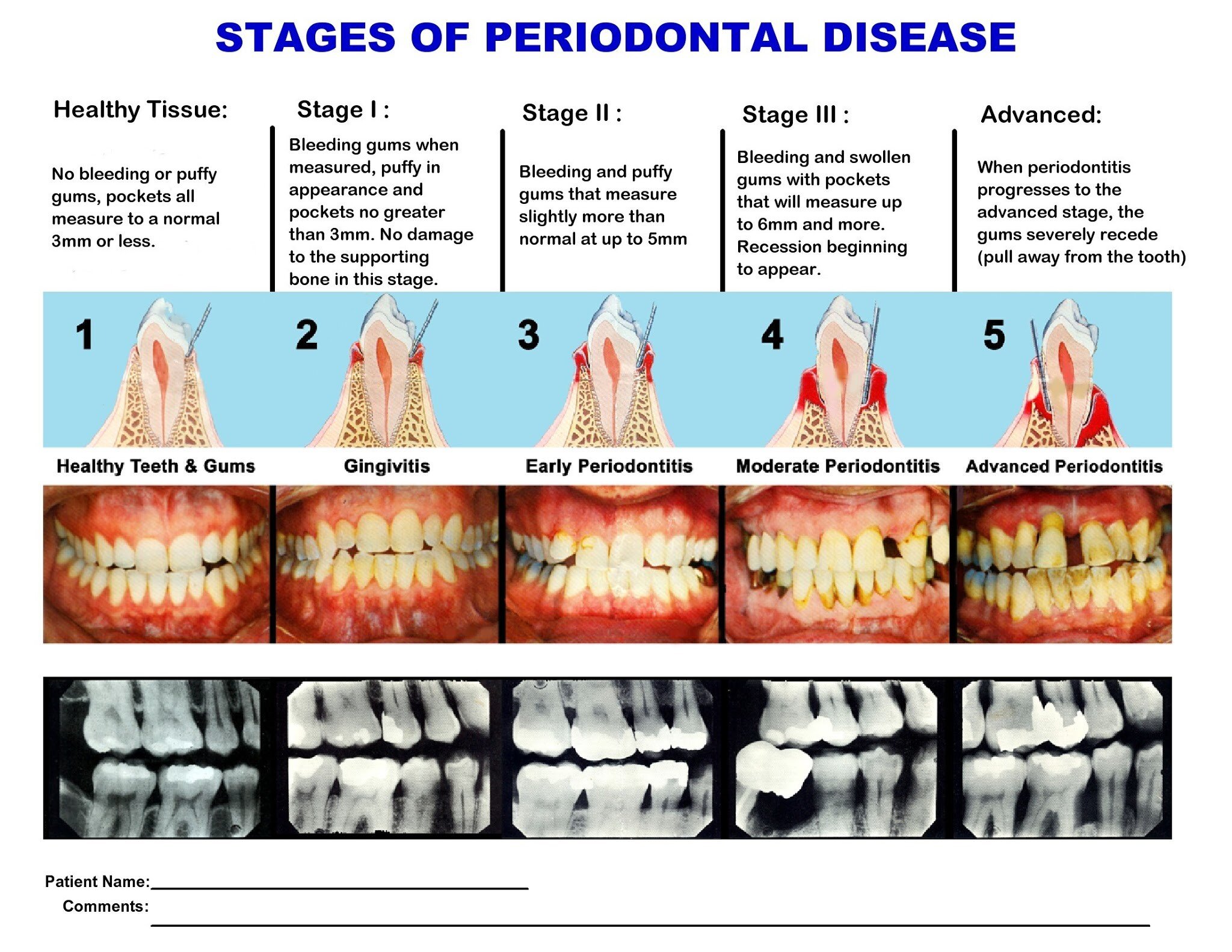 periodontal disease stages