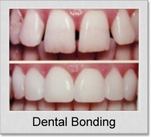 dental bonding 300x272 - Teeth Bonding