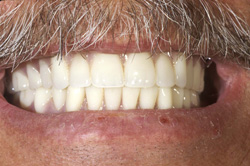 implant denture 3 (1) - Photo Gallery