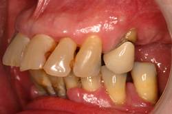 implant hybrid denture 1 - Photo Gallery